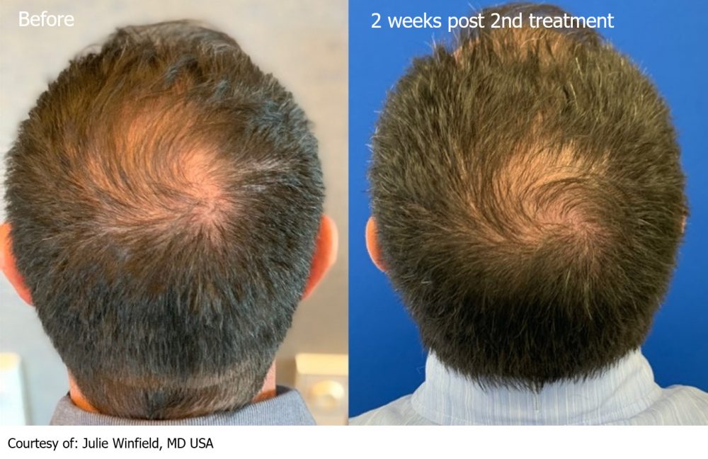 Keralase Hair Restoration - Tampa Bay Laser